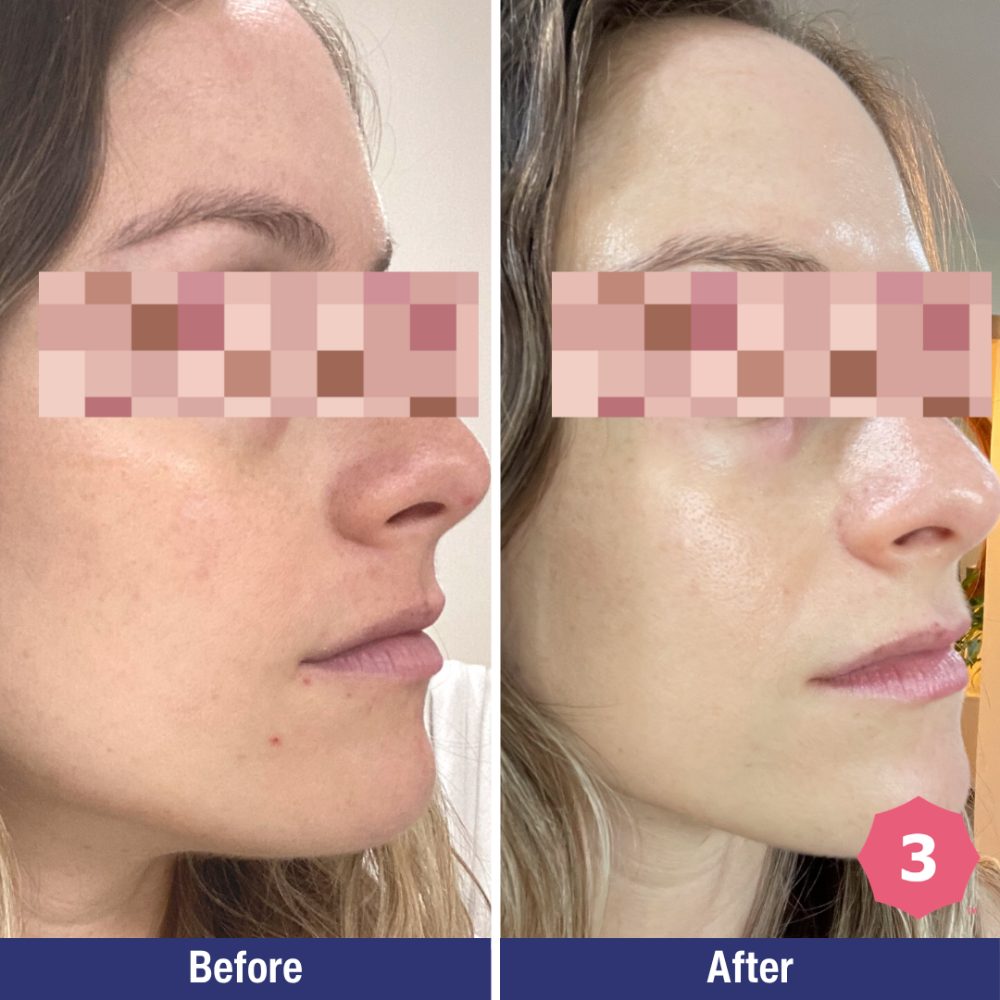 Before and after result